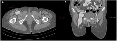 Frontiers Case Report Gigantic Arteriovenous Femoral Fistula